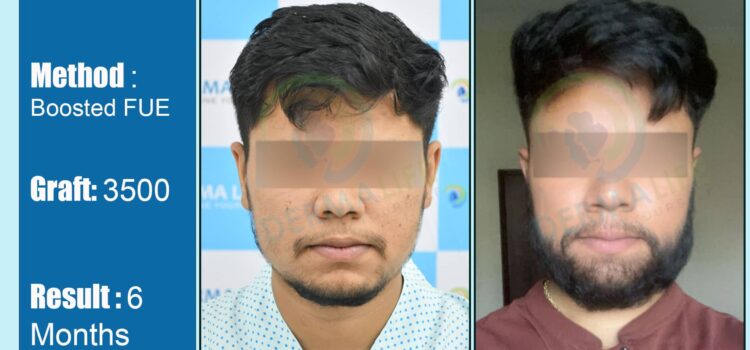 How to Find The Best Clinic for Beard Hair Transplant in Delhi 
